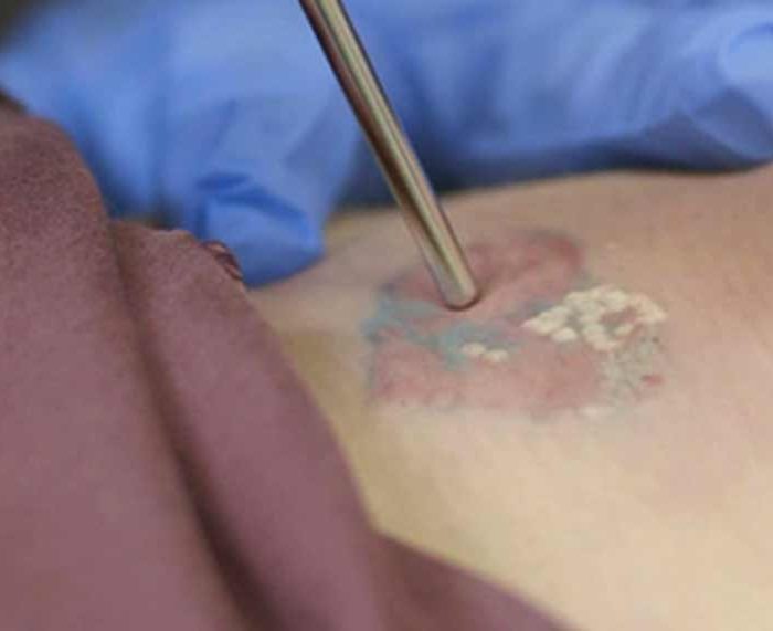 Empower. Evolve. enlighten™. Picosecond Tattoo Removal and a High-Volume Practice