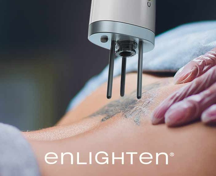 enlighten: How the Best Tattoo Removal Solution Became My Practice’s Workhorse